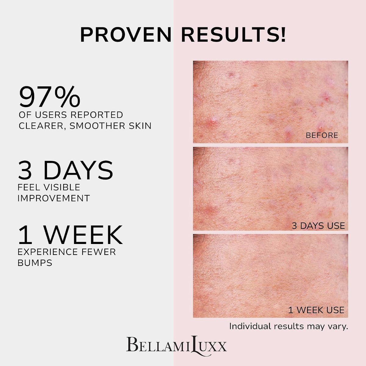 BellamiLuxx Butt Acne Clearing Treatment Cream: Body Acne Treatment Lotion
