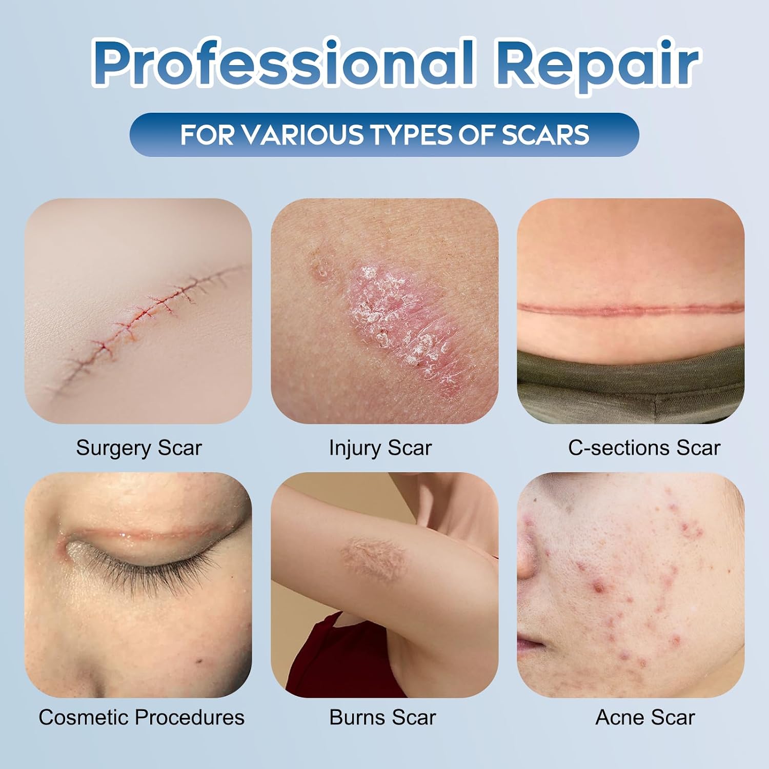 Glowor Advanced Silicone Scar Gel for Face & Body for Old
